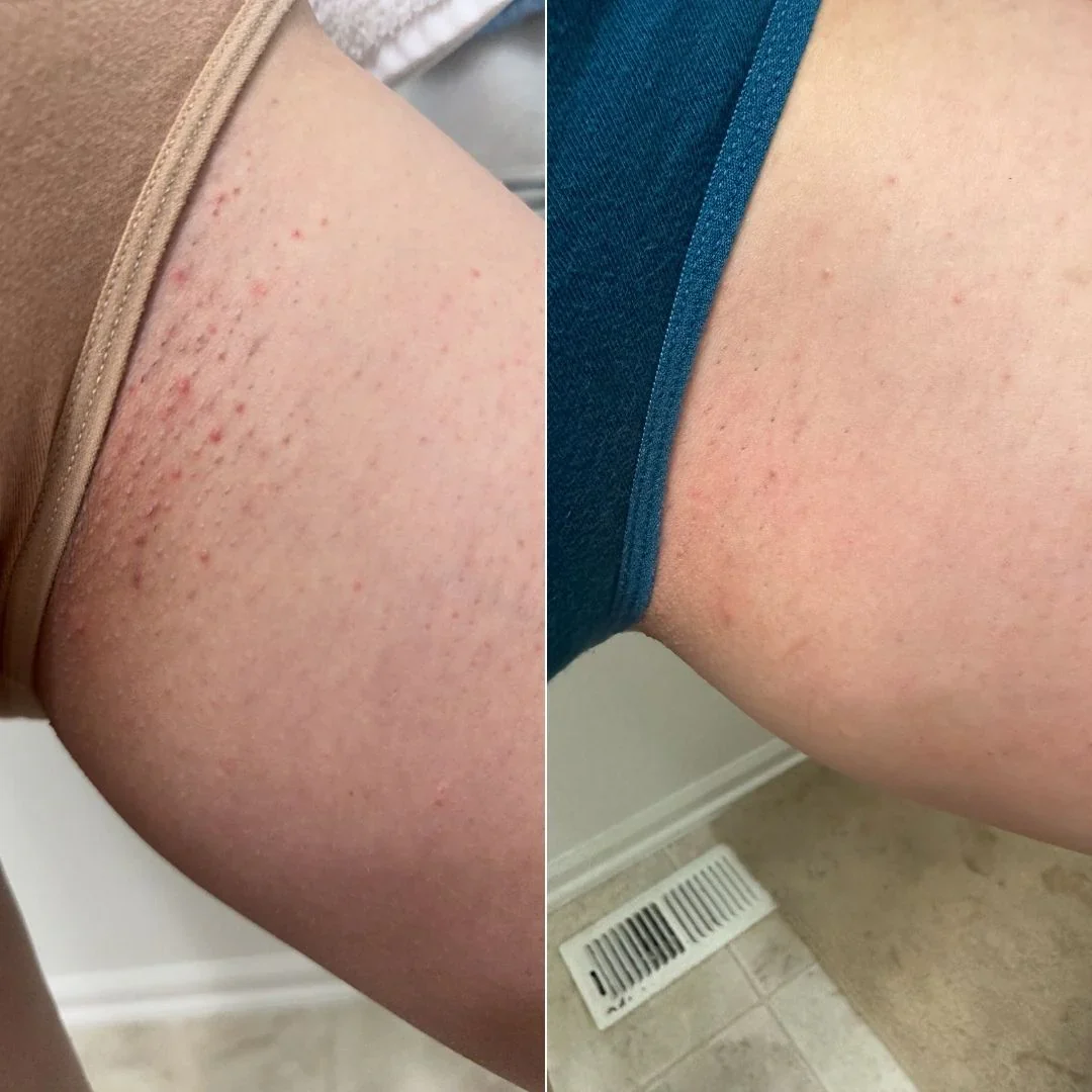 Before and after on bikini line, side by side