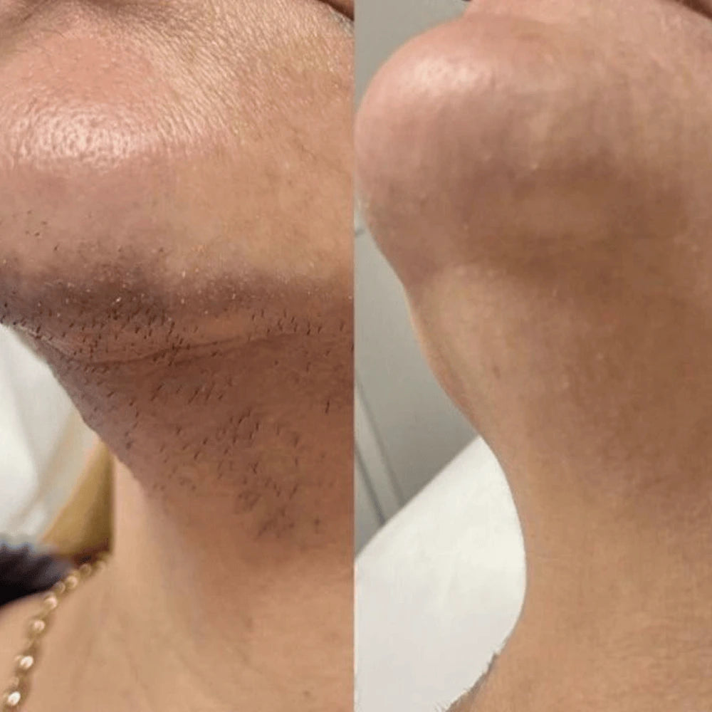 Before and after on upper lip and chin, side by side