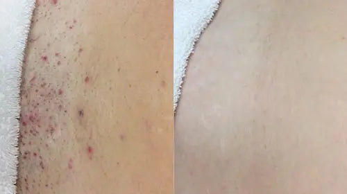 Before and after on underarms, irritated skin on left and even skin on right