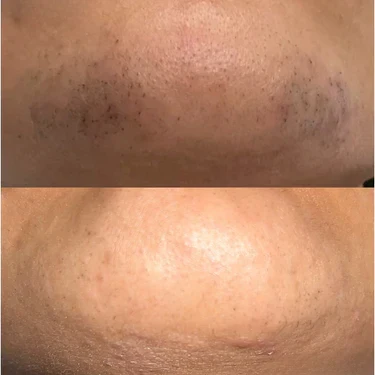 Before and after on chin, close-up